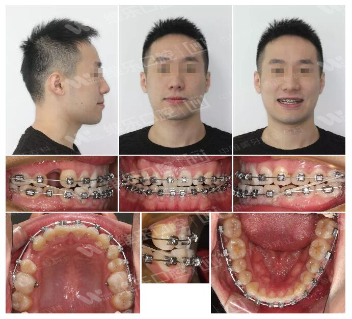 精准正畸 insignia矫正地包天,牙齿不齐